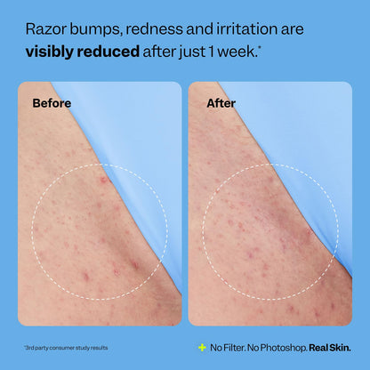 Peach Slices - Smoothing Solution Ingrown Hair Treatment